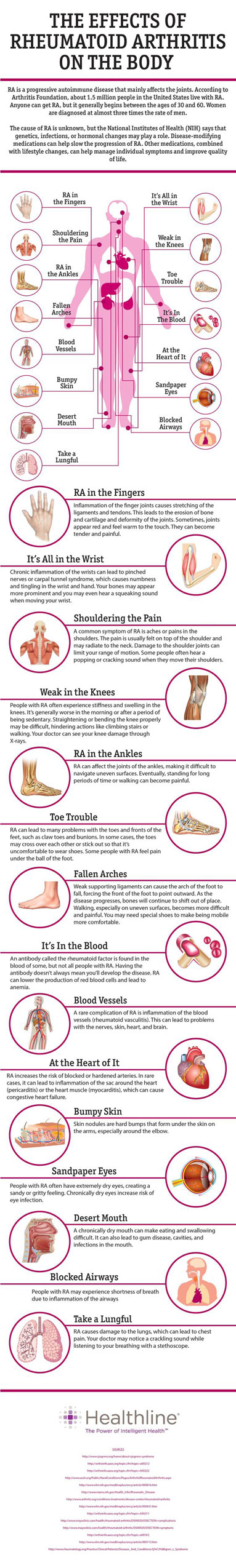 Artritis-Infografia