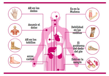 Artritis