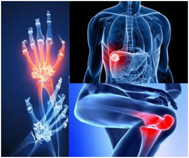 Artritis_post